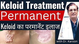 Keloid Removal Treatment  Keloid का इलाज  Dr Karoon Agrawal [upl. by Geerts]