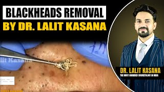 BLACKHEADS REMOVAL BY DR LALIT KASANA [upl. by Bremen]