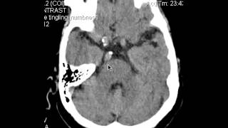 CT Head 74yoF w Facial pain w Trigeminal Impression DISCUSSION by Radiologist [upl. by Rourke]