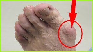 Bunion Removal  How To Get Rid Of Bunions Naturally  Shrink Bunions Naturally [upl. by Ahsille236]