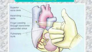 34 Transverse sinus of pericardium [upl. by Linell]