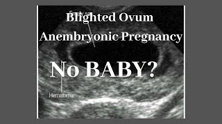 ANO ANG BLIGHTED OVUM or ANEMBRYONIC PREGNANCY WAG MAWALAN NG PAGASA MAY CHANCE PA MABUO ANG BABY [upl. by Kahler]