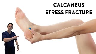 Does shockwave treatment help a calcaneus stress fracture heal [upl. by Zendah]