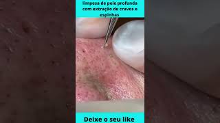 😃 limpeza de pele profunda com extração de cravos e espinhas  cravos e espinhas 😃😉 [upl. by Tattan91]