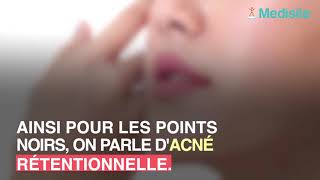 Point noir  comment apparaîtil [upl. by Storer]