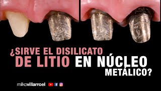 ¿Puedo utilizar disilicato en núcleo metálico  Milko Villarroel [upl. by Aneerehs]