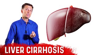 Is Liver Cirrhosis Reversible  Fibrosis vs Cirrhosis – DrBerg [upl. by Eilsew]