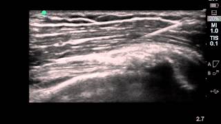 Left Biceps Tendon SVF  Stem Cell Therapy  Stem Cell Injection [upl. by Ronald]