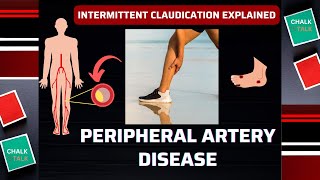 Peripheral Artery Disease PAD [upl. by Boigie]