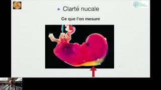 Dépistage De La Trisomie  Formation Echographie Obstétricale Maroc [upl. by Orgalim956]