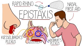 Understanding Epistaxis Nosebleeds Explained [upl. by Moina]