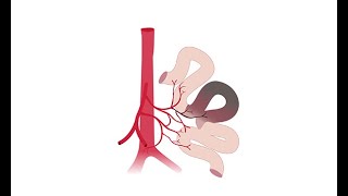 Recognizing acute mesenteric ischemia [upl. by Diraf]