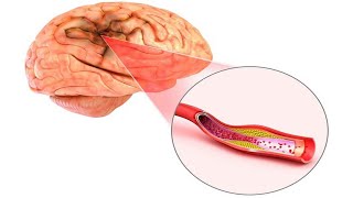 ASSESSMENT amp DIAGNOSTICS 97 Cerebral Arteriosclerosis Potency Sexual Desire Fertility Rhinitis [upl. by Udelle]