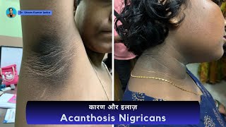 Acanthosis nigricans Treatment  dark neck treatment  काले गर्दन का इलाज  Dr Uttam Kumar Lenka [upl. by Mihcaoj]