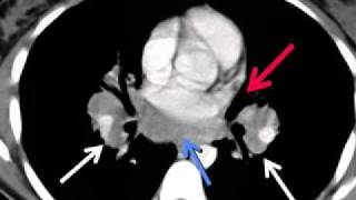 LearningRadiology 55 Sarcoidosis [upl. by Forcier]