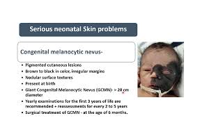 Congenital Melanocytic Nevus  Spot Diagnosis 27  Pediatrics [upl. by Nella]