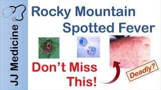 Rocky Mountain Spotted Fever  Bacteria Signs amp Symptoms Diagnosis and Treatment [upl. by Zizaludba]