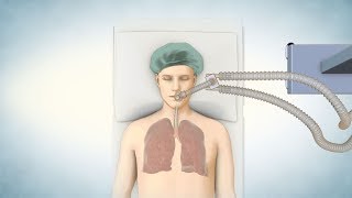 Lung Transplant Process [upl. by Ermengarde149]