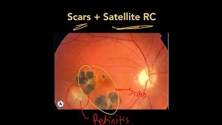 High Yield Topic Ocular Toxoplasmosis [upl. by Sgninnej]