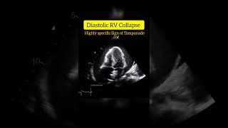 Diastolic RV Collapse is Highly Specific sign of Cardiac Tamponade echocardiography cardiology [upl. by Yendis]