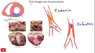 Myocardial ischemia amp infarction  STEMI NSTEMI Q wave infarction Wellens syndrome [upl. by Assiran280]