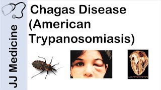 Chagas Disease  American Trypanosomiasis  Causes Symptoms and Treatment [upl. by Mellie]