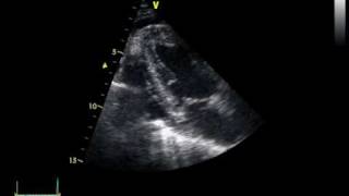 CHRONIC PERICARDITIS with thickening of the pericardium [upl. by Ahseel]