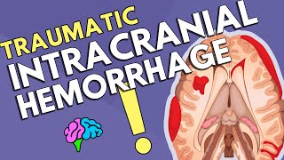 Intracranial Hemorrhage [upl. by Ecidnak650]