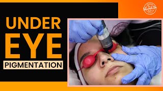 Laser treatment for dark circles under eyes  Under Eye Pigmentation Removal [upl. by Esenej]