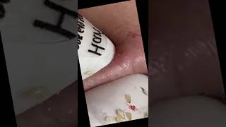 Blackhead Removal Acne Removal Treatment 056 [upl. by Dorion]