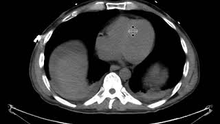 Hematoma with active extravasation [upl. by Musser]