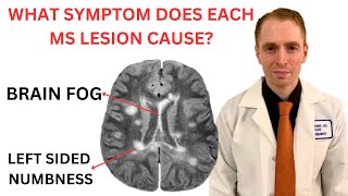 What Symptom Does Each Multiple Sclerosis MRI Lesion Cause Neurologist Explains [upl. by Yarg]