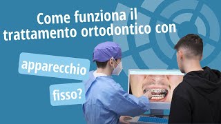 Trattamento ortodontico con apparecchio fisso come funziona  Studio Ortodontico Cocconi Rapa [upl. by Navets91]