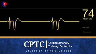 Extrasístole Ventricular [upl. by Nami]