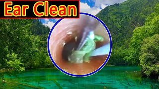 Ear wax removal amp Ear Cleaning （11） [upl. by Chantalle231]