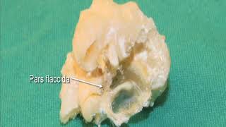 18 Step 7 Internal view of tympanic membrane and associated ossicles isolated specimen [upl. by Milstone]