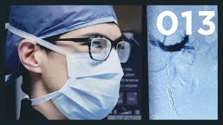 Treating Infertility with Metallic Coils  Varicocele Embolization Procedure  Vlog013 [upl. by Penland]