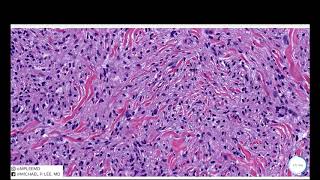 Juvenile Xanthogranuloma JXG Dermpath Made Easy [upl. by Scharaga]