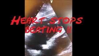 Cardiology Echo QuizCase Heart stops beating Part 1 SCD VT SVT AVRT AVNRT Sinus Tach [upl. by Haslam]