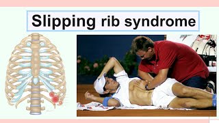 slipping rib syndrome [upl. by Aenahs]