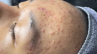 ACNE TREATMENT VU QUYNH MI  Blackheads Perennial EveryWhere Squeeze Forehead [upl. by Jackquelin]