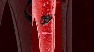 Atrial Fibrillation Explained  ECG  Afib Treatment  Management [upl. by Essenaj]