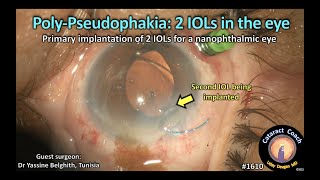 CataractCoach 1610 poly pseudophakia 2 IOLs in the eye [upl. by Zachar]