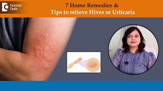 7 Home Remedies to Get Rid of Hives Fast  Urticaria Treatment DrAmee Daxini Doctors Circle [upl. by Arde]