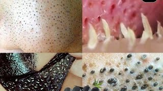 Isto Elimina ESPINHAS Inflamadas e Tira Cravo No Nariz em 1 Noite😱😱😱 [upl. by Tessy]