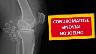 JOELHO  CONDROMATOSE SINOVIAL [upl. by Jamey316]