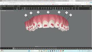 Invisalign  step by step guide [upl. by Terrell]