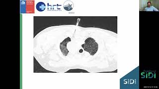 Casos desafiantes en Radiología Intervencionista  Webinar Academia SIDI  Diciembre 2023 [upl. by Ettennod]