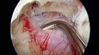 Endoscopic Lumbar Discectomy [upl. by Okeim]