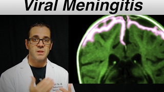 viral meningitis  Patient Education Video [upl. by Hepsiba35]